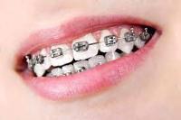 Braces Club