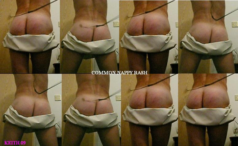 diaper th-rash!
sequence of sore buttocks
Keywords: sore buttocks